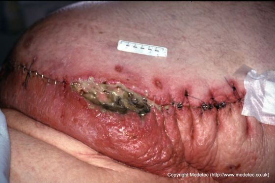 Dehisced Surgical Wound, Bariatric Patient Dehisced Surgical Wound, Bariatric Patient