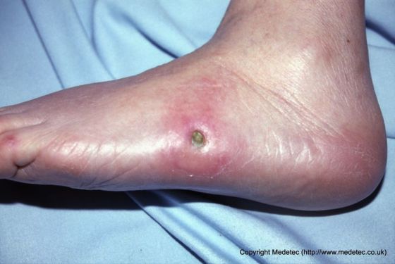 Diabetic Foot Ulcer Diabetic Foot Ulcer