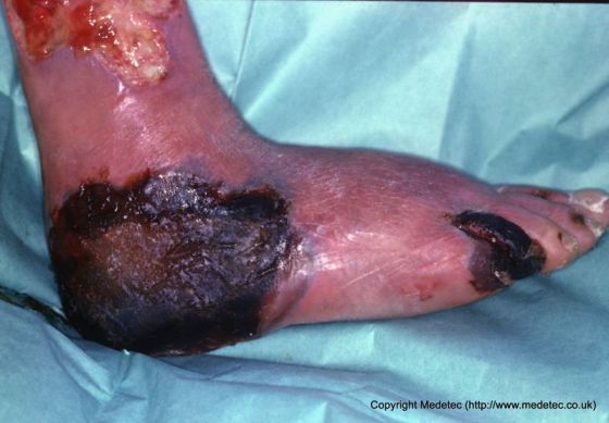 Necrotic Foot, Diabetic Ischemic Ulcer Diabetic Foot, Ischemic with Necrosis
