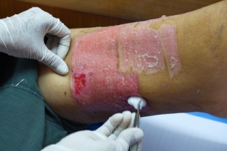 Skin graft donor site Skin graft donor site