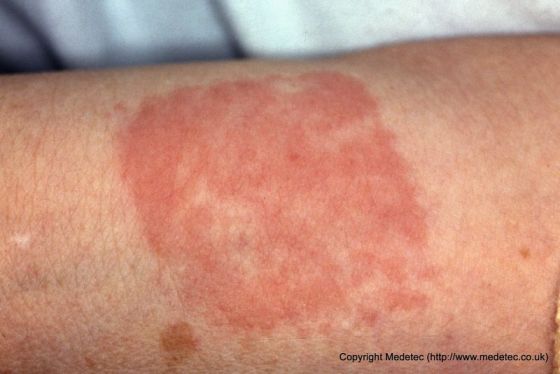 Reaction to hydrocolloid dressing Reaction to hydrocolloid dressing