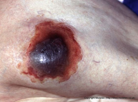 Pressure Ulcer, Deep Tissue Injury Pressure Ulcer, Deep Tissue Injury