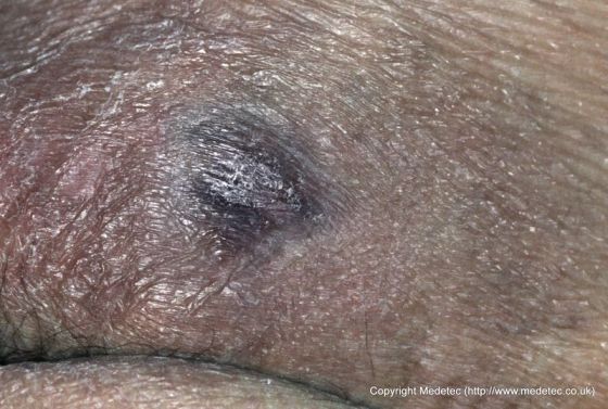 Pressure Ulcer, Deep Tissue Injury Pressure Ulcer, Deep Tissue Injury