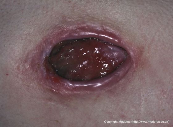 Pressure Ulcer on Hip, Stage III Pressure Ulcer on Hip, Stage III