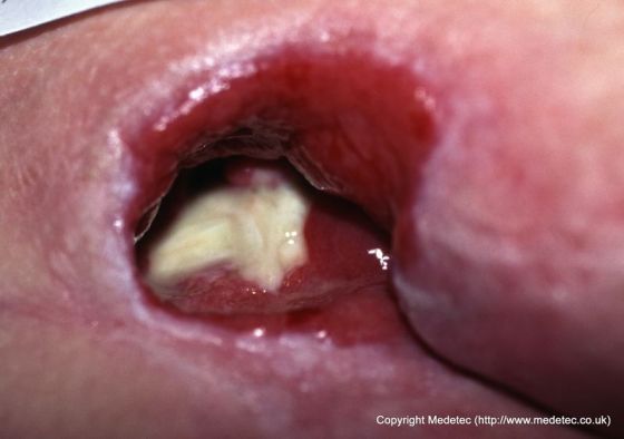 Sacral Pressure Ulcer, Stage IV Sacral Pressure Ulcer, Stage 4