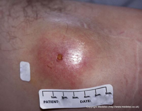 Pressure Ulcer Formation, Stage I Pressure Ulcer Formation, Stage I