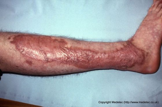Skin graft site, lower leg Skin graft site, lower leg