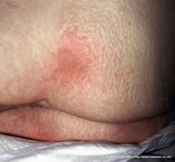 Pressure Ulcer, Stage I Development Pressure Ulcer, Stage I Development